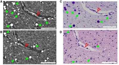 Distribution of corpora amylacea in the human midbrain: using synchrotron radiation phase-contrast microtomography, high-field magnetic resonance imaging, and histology